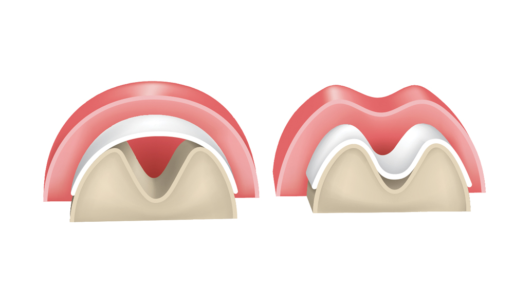 The Use of Barrier Membranes in Implant Dentistry