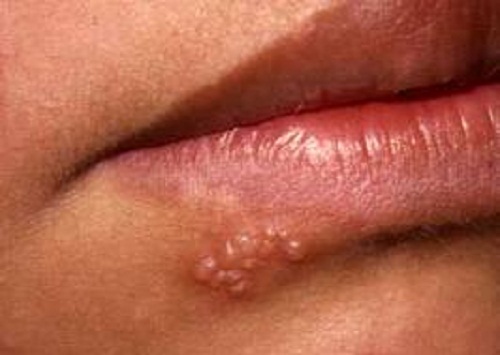 7. Câu hỏi thường gặp về Herpes miệng