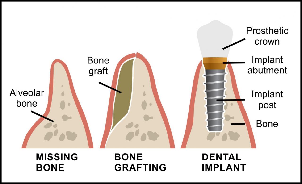 Ghép xương trong nha khoa Bone_grafting